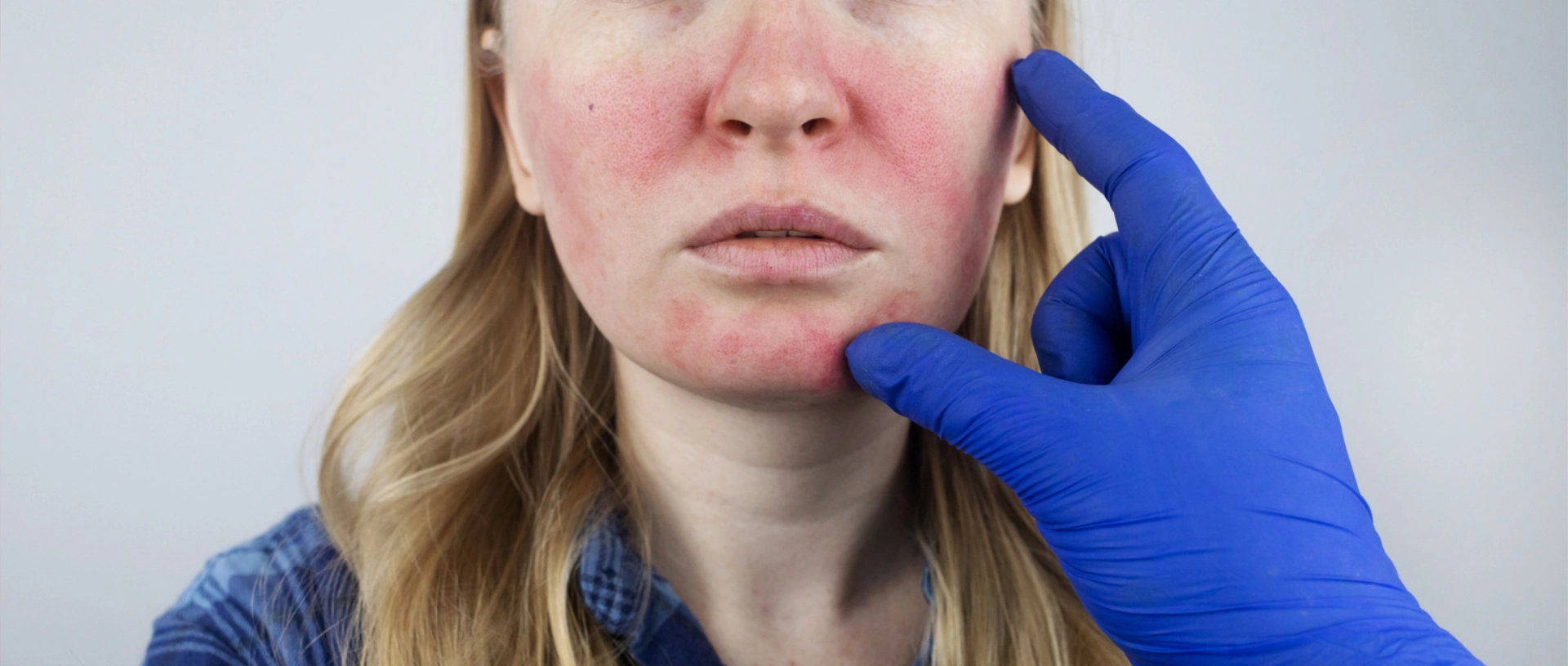 Understanding Rosacea: Causes, Symptoms, Triggers, and Treatment