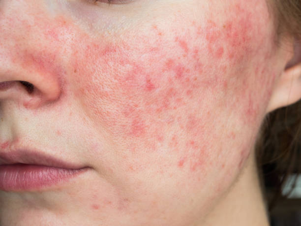 Understanding Rosacea: More Than Just a Red Face"